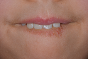 お子さんの 口唇噛み が原因で起こる歯並びの異常 歯並び おまかせ Com