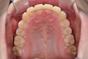 前歯の二重歯列も この方法なら非抜歯でキレイに歯列矯正できる 歯並び おまかせ Com
