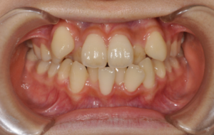 重度の二重歯列を改善するための 抜歯ありこだわりの歯列矯正法 歯並び おまかせ Com