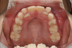 下アゴがゆがみの原因は 前歯の二重歯列 にじゅうしれつ にあった 歯並び おまかせ Com