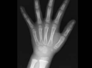 歯の矯正治療なのに 手 のレントゲン写真を撮影する理由 歯並び おまかせ Com