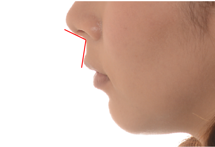 上顎前突症における外科手術と、外科手術後の横顔の変化　